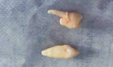 Răng hàm xuyên qua sọ nam sinh sau va chạm giao thông