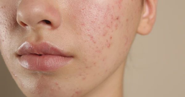 Review chấm mụn viêm mới Trioderma Intensive Acne Spot Gel: ‘Cứu tinh’ cho làn da