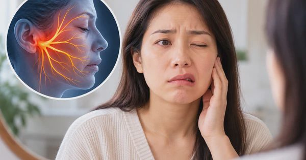 Sáng ngủ dậy méo miệng có phải do 'trúng gió'? Bác sĩ giải đáp
