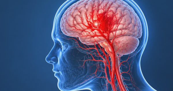 Sau tuổi 50, huyết áp bao nhiêu thì tăng nguy cơ đột quỵ?