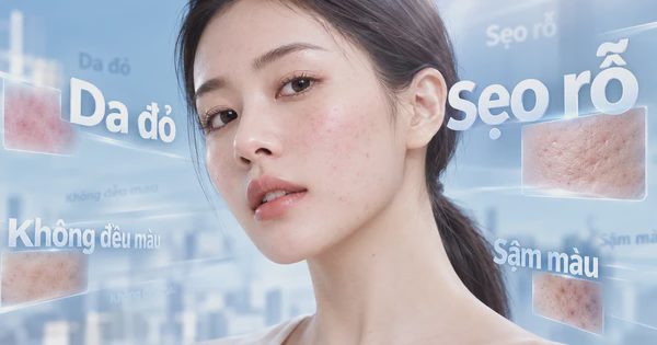 Sẹo rỗ nông sau mụn: Chăm sóc thế nào để bề mặt da trông mịn màng hơn?