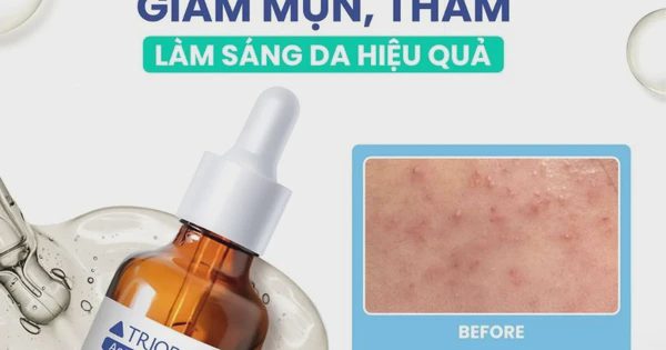 Serum giúp ngừa mụn, sáng da Trioderma ActiBalance+ Serum có tốt không mà ‘cháy hàng’ liên tục?