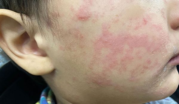 Số ca mắc sởi ở Mỹ vượt hơn 4.500 ca, 479 bệnh nhân phải nhập viện
