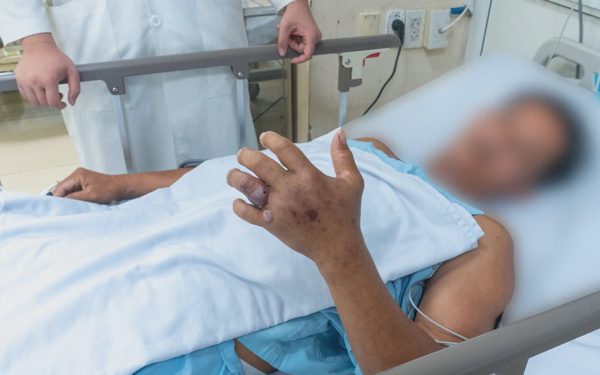 Số ca nhập viện do rắn cắn tăng mạnh, có ca nôn ra máu sau 20 phút bị cắn