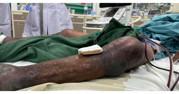 Sốc nhiễm khuẩn, suy đa tạng sau khi ăn tiết canh
