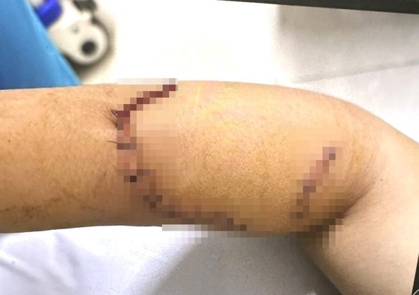 Sức khỏe nữ sinh lớp 9 bị bạn dùng dao tấn công gây đa thương tích ở Đắk Lắk