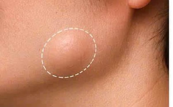 Thấy khối u mỡ ở vùng đầu, cổ: Khi nào đáng lo?