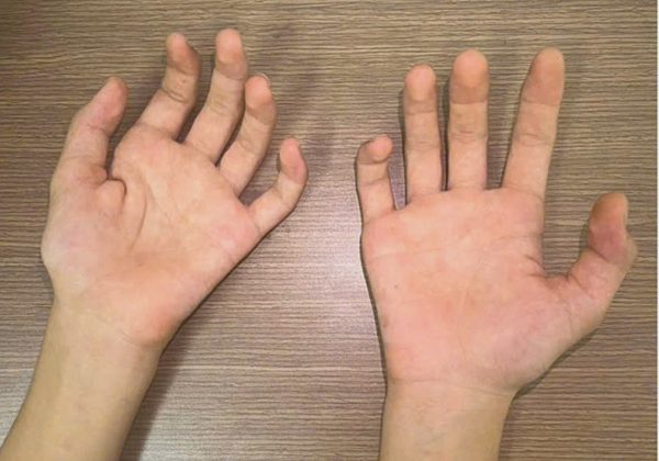 Thiếu niên bị teo cơ bàn tay bởi bệnh thần kinh ở nam giới trẻ