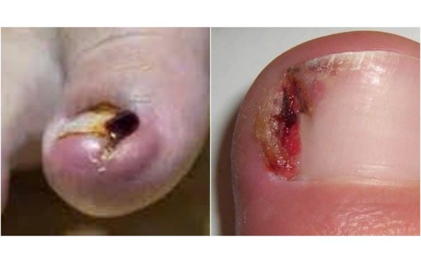 Thói quen cắt móng chân và đi giày có thể dẫn đến bệnh lý