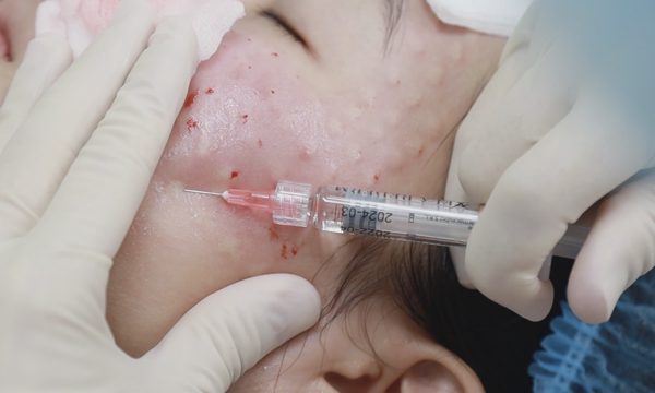 Tiêm botox, filler giả có thể gặp biến chứng gì?