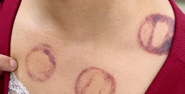 Tin giác hơi ‘hút máu độc’ phòng đột quỵ, có thể phải trả giá đắt