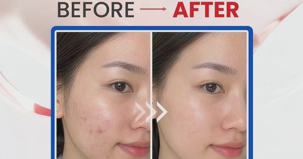 Top 5 kem chấm mụn giúp mụn viêm sưng xẹp sau khoảng 1 đêm ngừa sẹo thâm