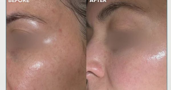 Top 5 kem giúp mờ nám chân sâu, đốm nâu hiệu quả sau khoảng 4 tuần