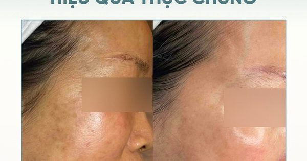Top 5 kem mờ nám hiệu quả với cả hỗn hợp lâu năm, hết hàng liên tục