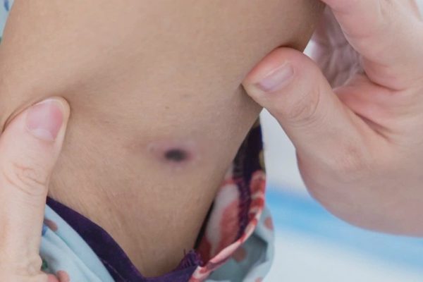 TPHCM: Người phụ nữ nhiễm trùng huyết sau khi dọn cỏ, phát hiện vết loét lạ
