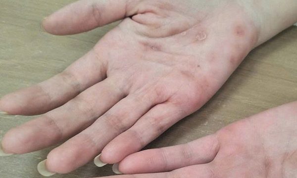 Từ nốt đỏ trong lòng bàn tay bất ngờ phát hiện giang mai