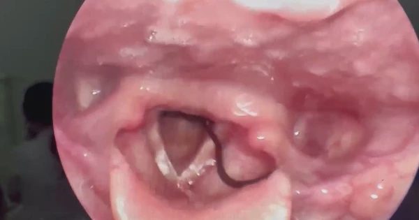 Tưởng bị u tuyến giáp, cô gái phát hiện đỉa sống trong họng