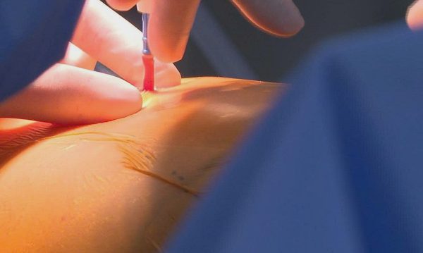 Tưởng phổi tắc nghẽn trở nặng hóa ung thư phổi