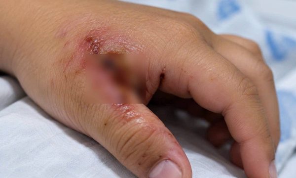 Uốn ván nặng, bé trai 7 tuổi co giật liên tục