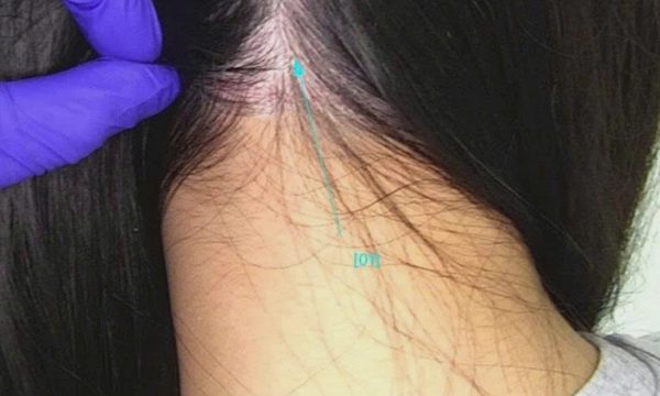 Vảy trắng đầu do viêm da mạn tính