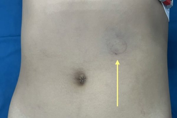 Vết bầm nhỏ sau tai nạn xe đạp, bé trai 10 tuổi phải mổ cấp cứu