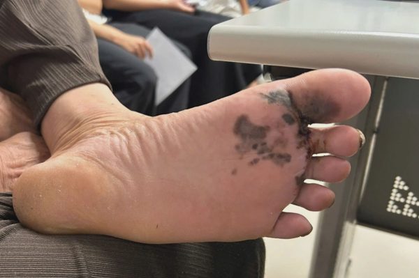 Vết đen tưởng vô hại ở chân cảnh báo loại ung thư da tử vong cao nhất
