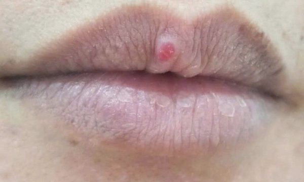 Vết trầy ở môi hóa u hạt nhiễm khuẩn