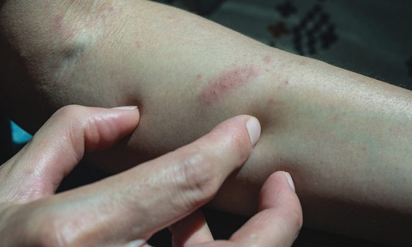 Vì sao bị sưng ngứa dữ dội khi muỗi đốt?