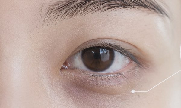 Vì sao bọng mắt xuất hiện?
