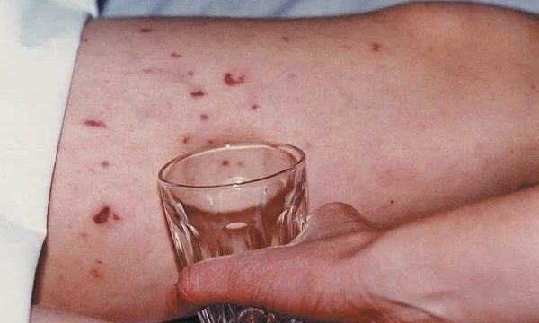 Vì sao ca não mô cầu có thể xuất hiện rải rác trong cùng khu vực?