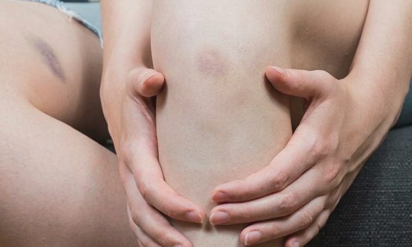 Vì sao da bạn dễ bị bầm tím?
