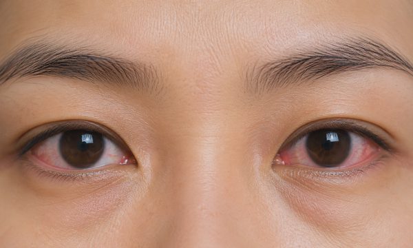 Vì sao đồng tử giãn ra?