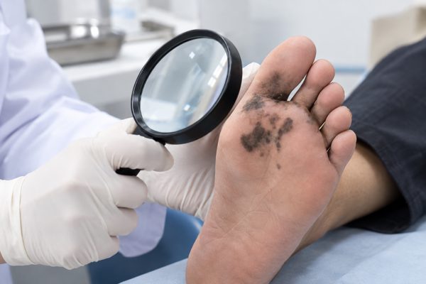 Vị trí 'ưa thích' của loại ung thư da ác tính, tỷ lệ tử vong cao nhất