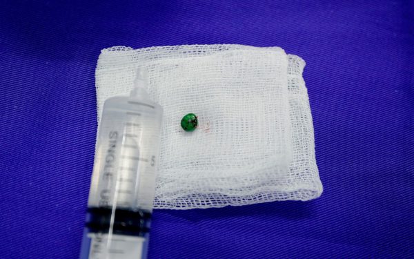 Viên bi lọt vào tai gây mất 60% thính lực, cảnh báo sai lầm khi xử trí