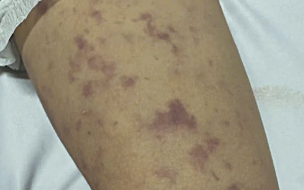 Xã Thường Tân, TP.HCM thông báo ghi nhận ca mắc não mô cầu ở trẻ 12 tuổi