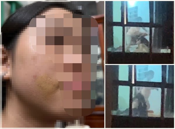 Xác minh vụ bé gái bị mẹ kế bạo hành ở Phú Thọ